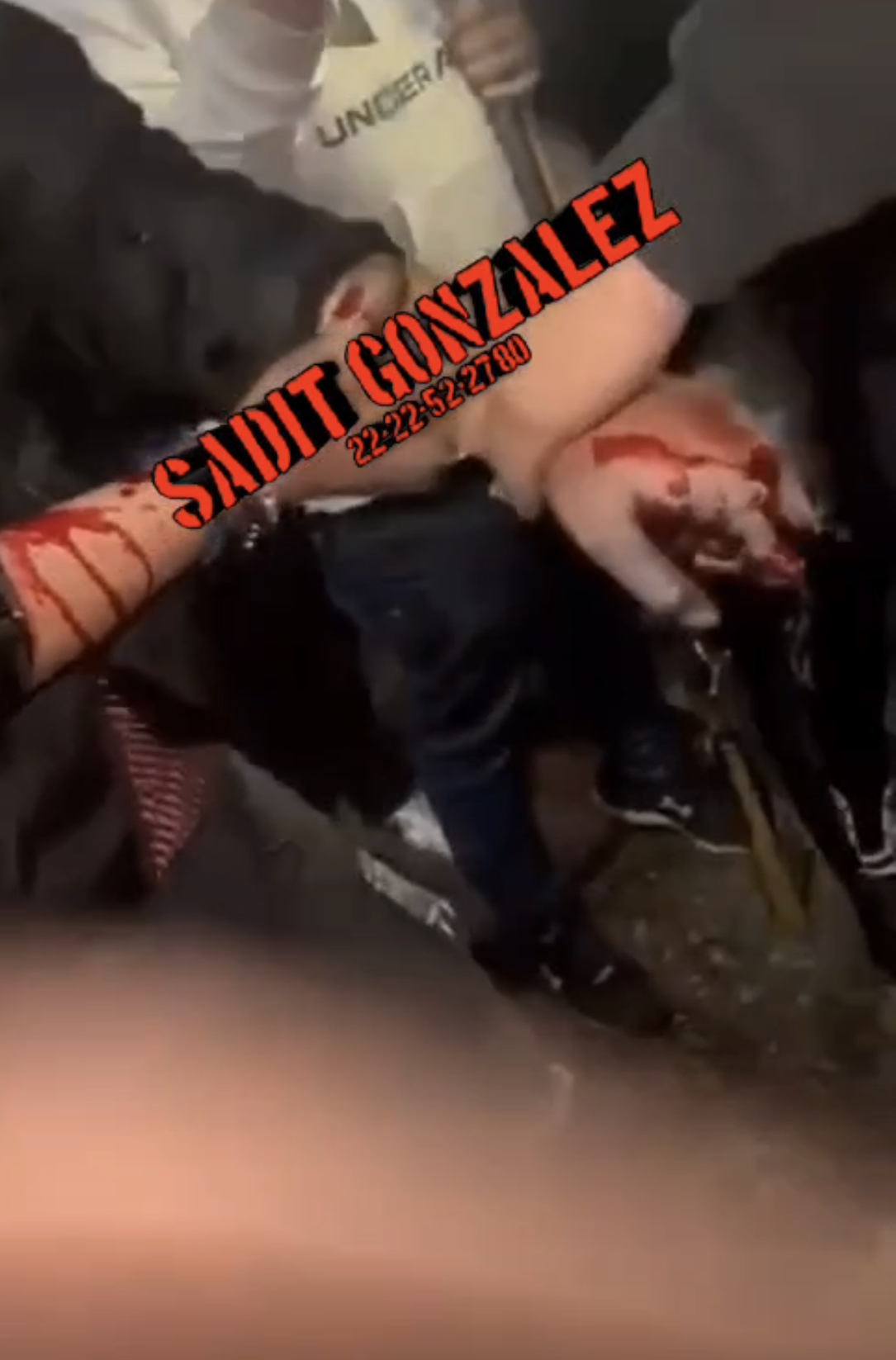 Joven pierde dedos de la mano en carnaval de Santa Ana Xalmimilulco